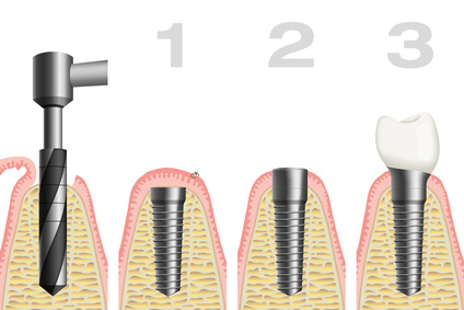 Zahnersatz Implantate